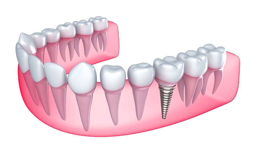 Dental procedure