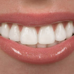 A Closer Look At Porcelain Veneers