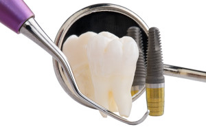 The Difference Between Mini And Standard Dental Implants