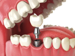 Answering Your Questions About Modern Dental Implants 