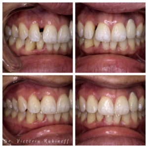 Cosmetic Dentistry before and after