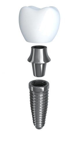 tooth implant