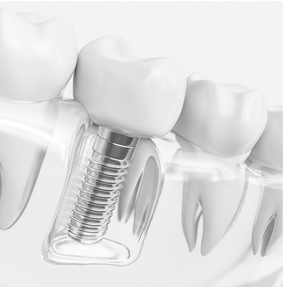 dental implant