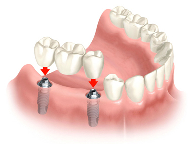 bridge implants