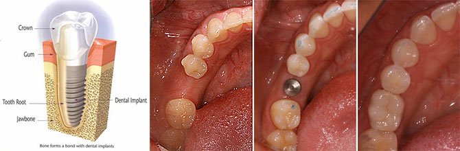 dental implant stages