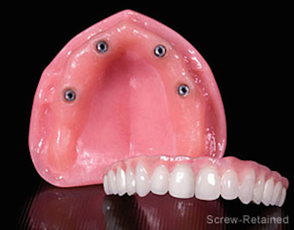 Implant Supported Upper Dentures