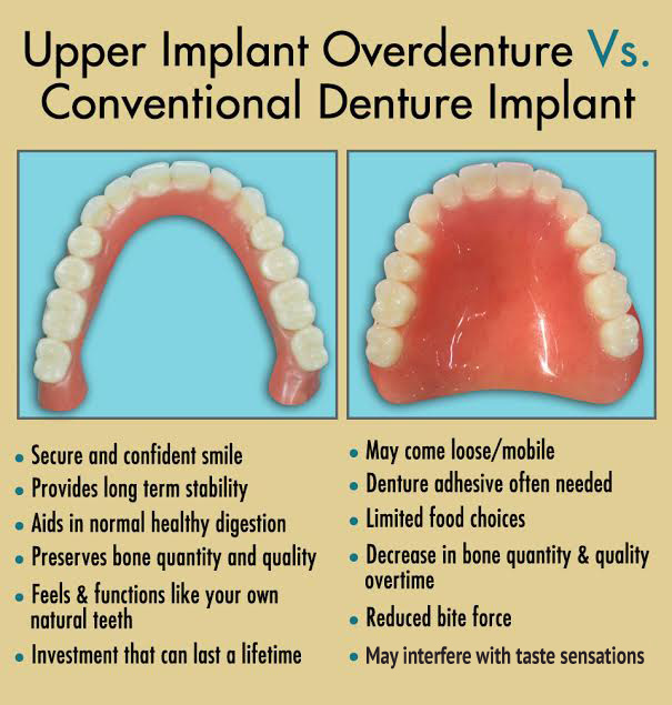 Upper Implant Overdenture vs. Conventional denture implant