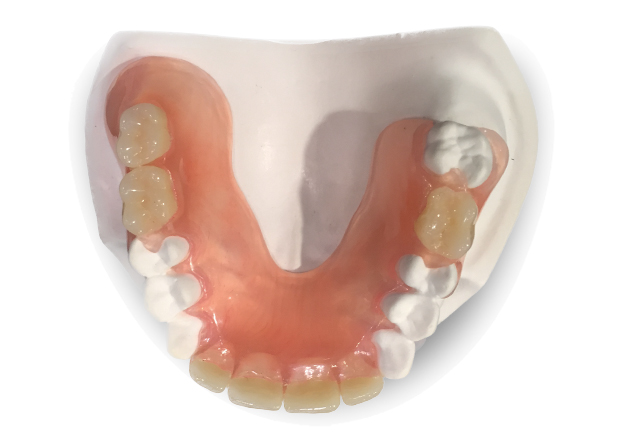 clear palata dentures