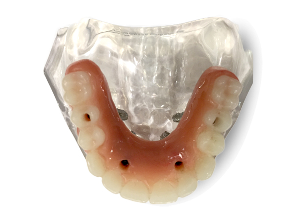 open palate implant supported dentures