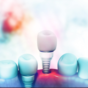 Shine Dental Group, Syosset, NY, Dental Implants