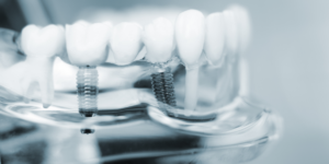 dental implant