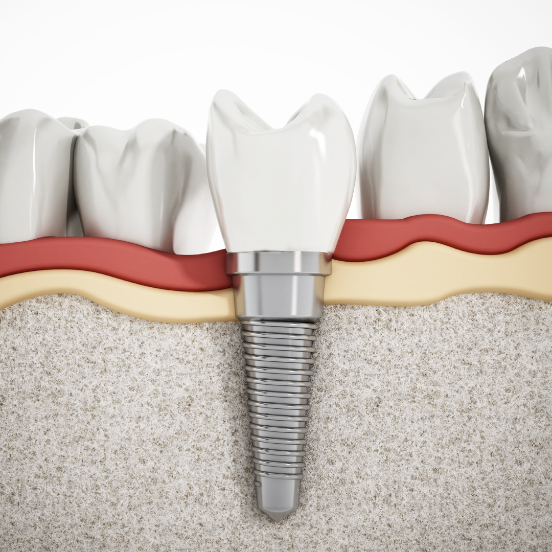 Dental Implants