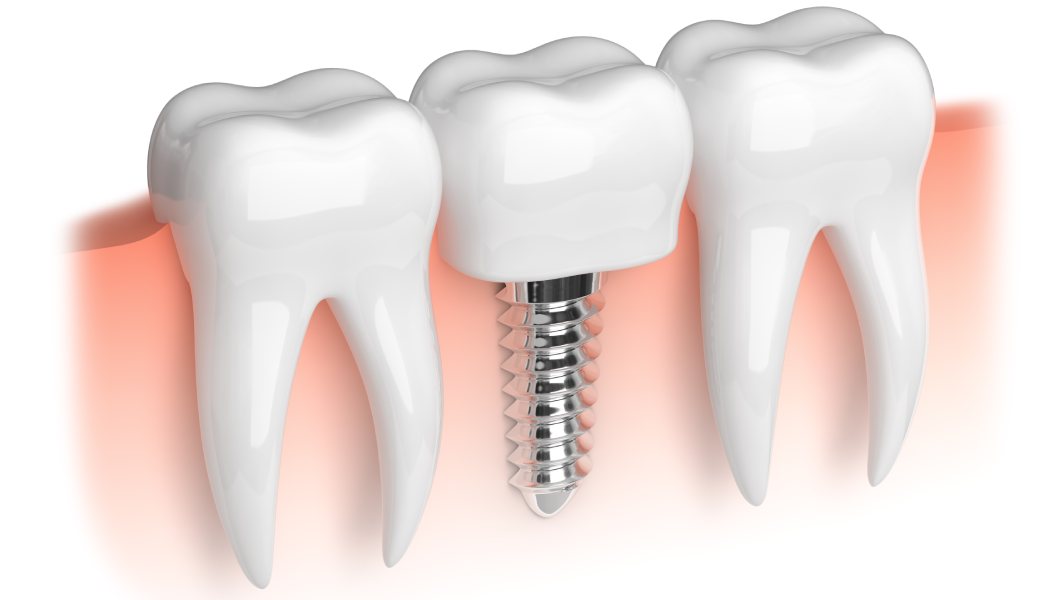 Dental Implants