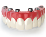 Teeth Replacement Options - Multiple teeth