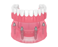 Teeth Replacement Options - Denture Implants