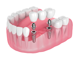 Teeth Replacement Options - implants multiple teeth