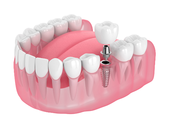 Teeth Replacement Options - Single Tooth Options