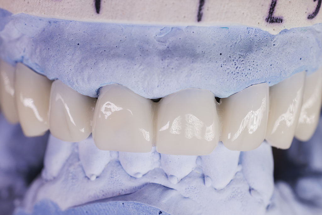 porcelain teeth at Shine Dental Associates